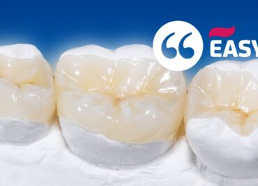 Intarsio dentale: che cosa è?